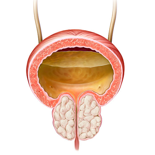 Próstata tumoral