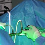Cirugía-de-próstata-con-láser-verde-o-con-robot-da-Vinci-1.jpg