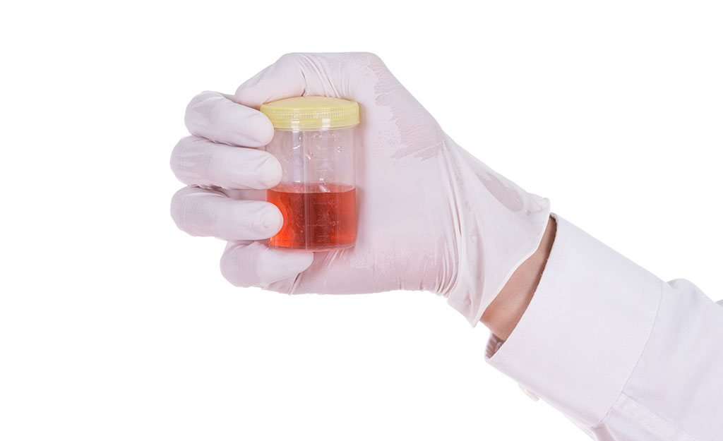 Qué hacer al echar coágulos de sangre en la orina