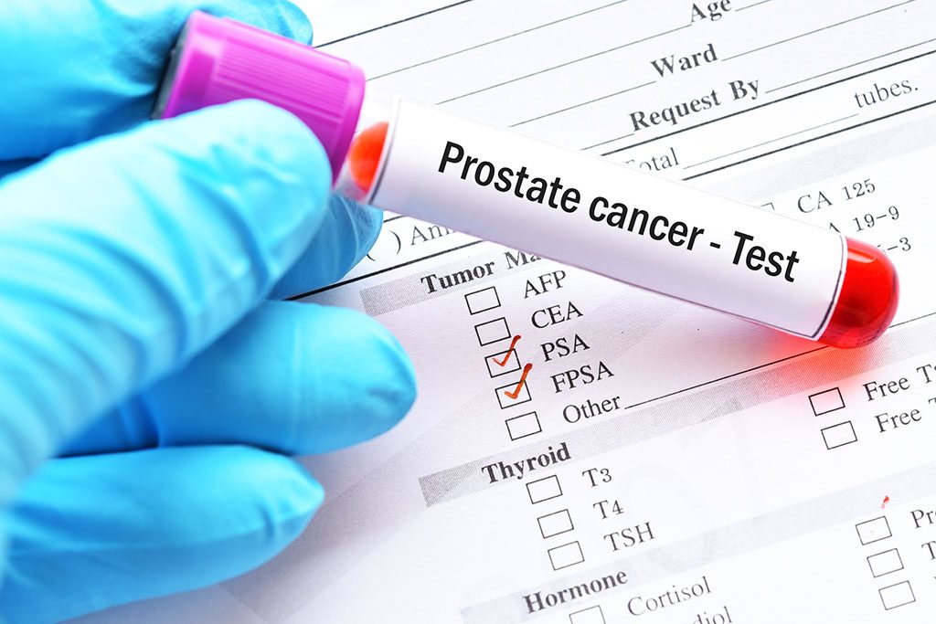 ¿Por qué hacer una revisión de próstata rutinaria?