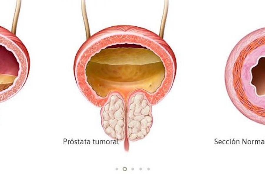 ¿Se cura el cáncer de próstata localizado?