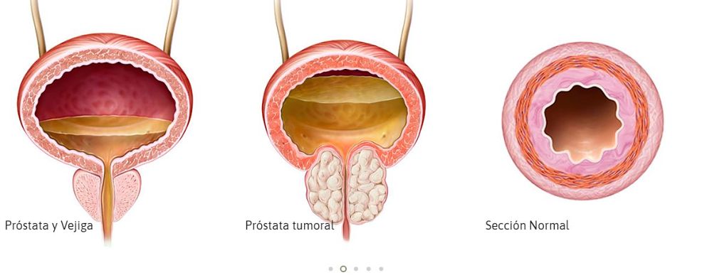 El cáncer de próstata se cura totalmente